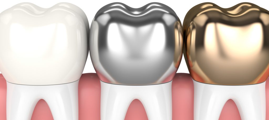 dental crowns