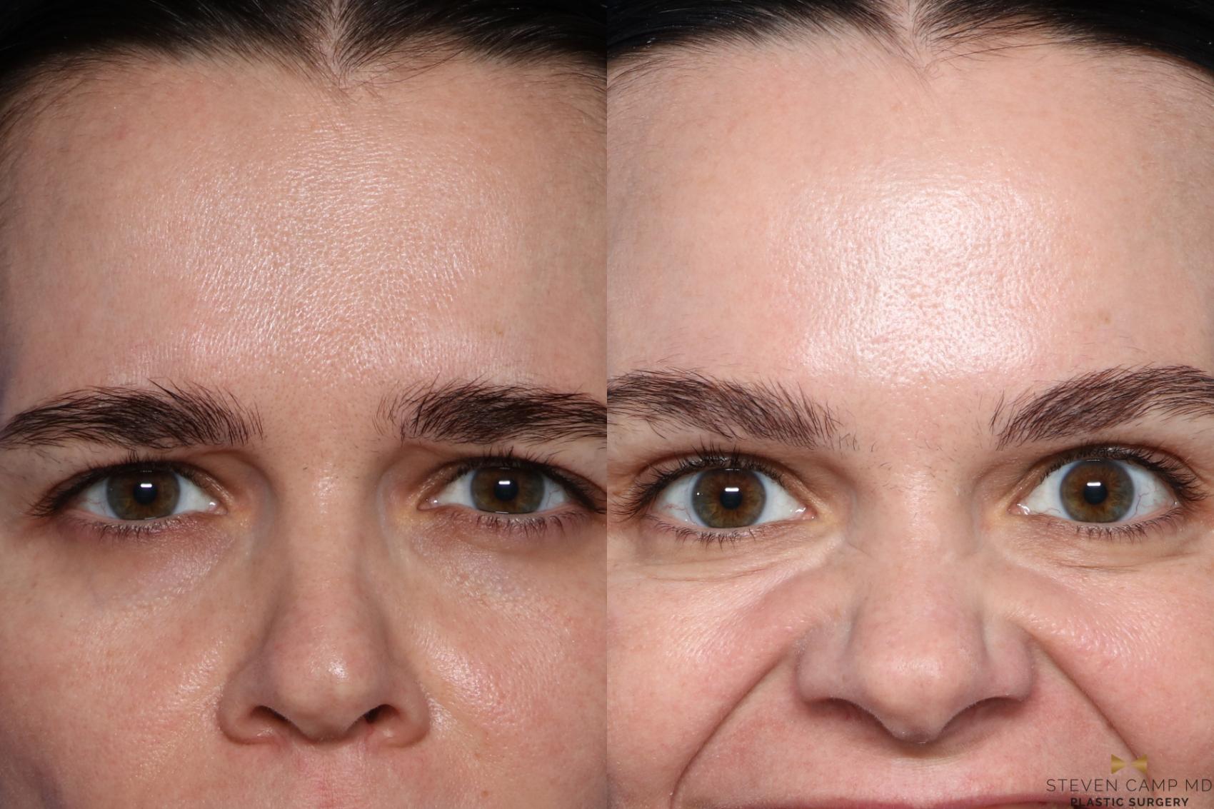 Botox vs. Fillers: What’s the Difference?